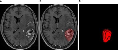 Transfer Learning-Based Autosegmentation of Primary Tumor Volumes of Glioblastomas Using Preoperative MRI for Radiotherapy Treatment